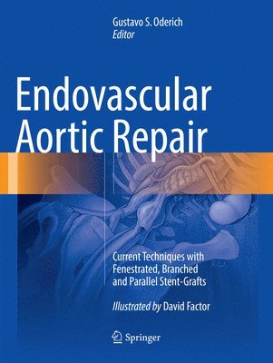 bokomslag Endovascular Aortic Repair
