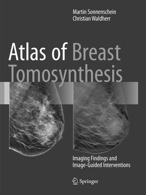 Atlas of Breast Tomosynthesis 1