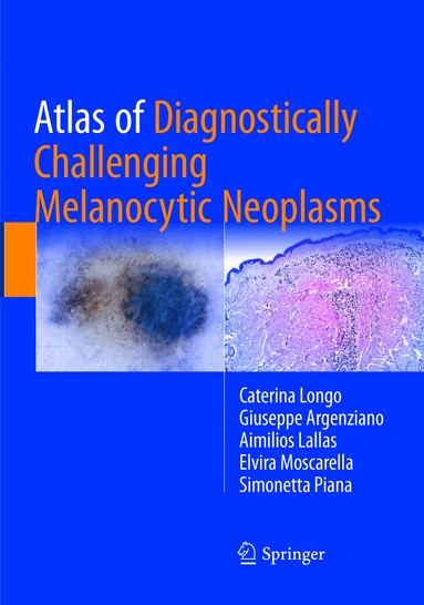 Caterina Longo, Giuseppe Argenziano, Aimilios Lallas, Elvira Moscarella, Simonetta Piana - Atlas of Diagnostically Challenging Melanocytic Neoplasms, Häftad