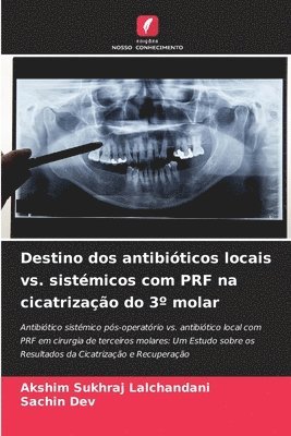 bokomslag Destino dos antibióticos locais vs. sistémicos com PRF na cicatrização do 3° molar