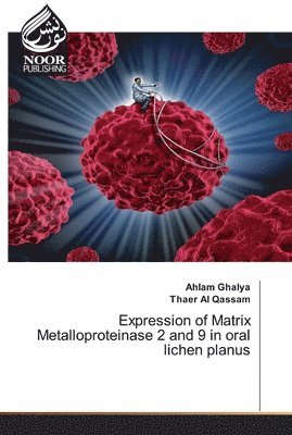 Expression of Matrix Metalloproteinase 2 and 9 in oral lichen planus 1