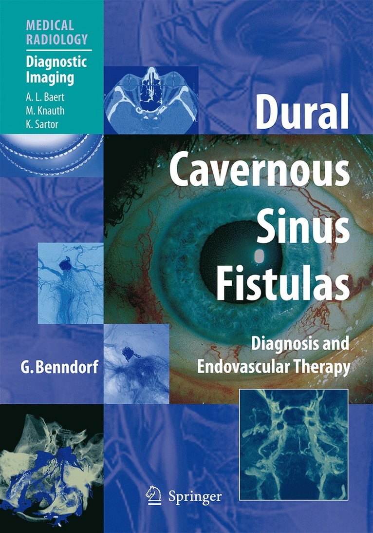 Goetz Benndorf - Dural Cavernous Sinus Fistulas, Inbunden
