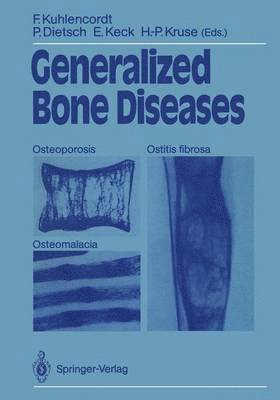 Generalized Bone Diseases 1