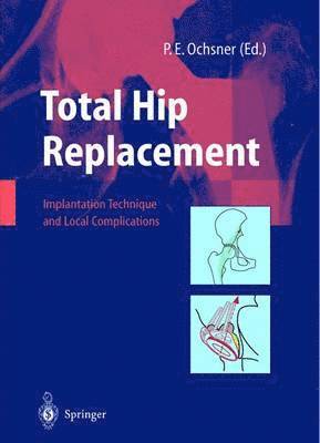 Total Hip Replacement 1