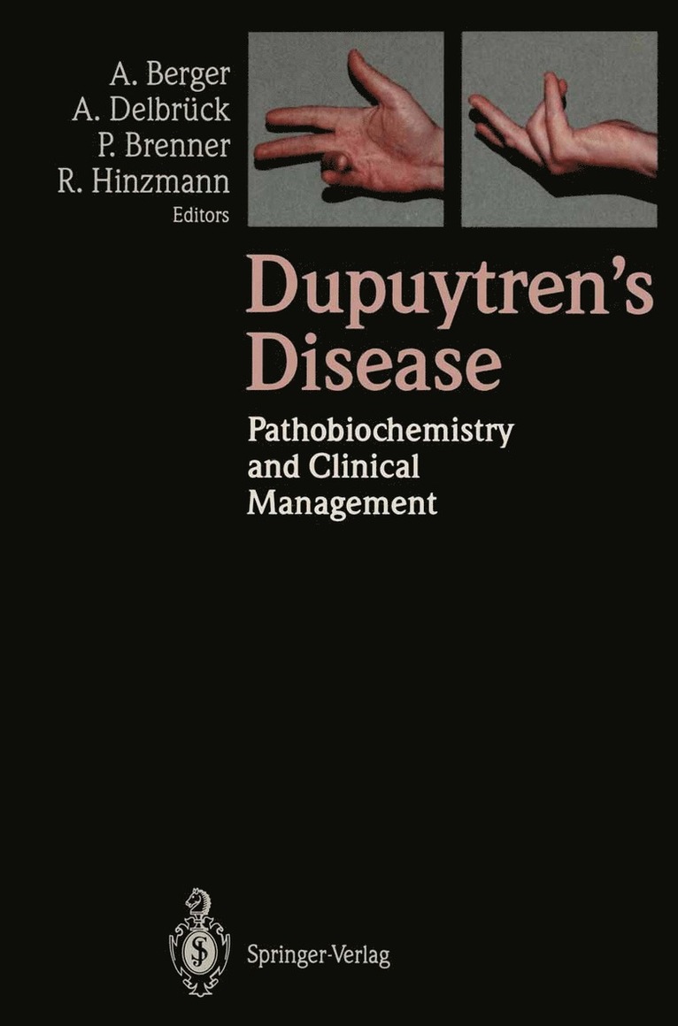 Alfred Berger, Axel Delbrück, Peter Brenner, Rolf Hinzmann - Dupuytren’s Disease, Häftad