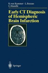 bokomslag Early CT Diagnosis of Hemispheric Brain Infarction