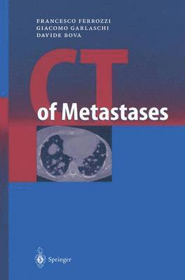 CT of Metastases 1