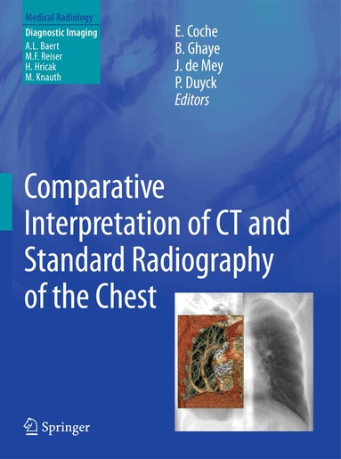 Emmanuel E. Coche, Benoit Ghaye, Johan de Mey, Philippe Duyck - Comparative Interpretation of CT and Standard Radiography of the Chest, Inbunden