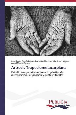 Artrosis Trapeciometacarpiana 1