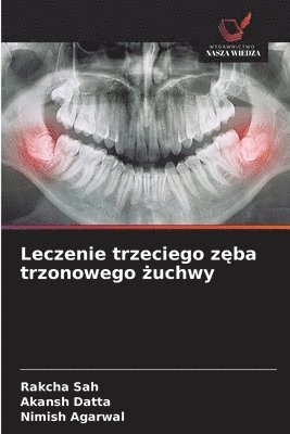 Rakcha Sah, Akansh Datta, Nimish Agarwal - Leczenie trzeciego zęba trzonowego żuchwy, Häftad