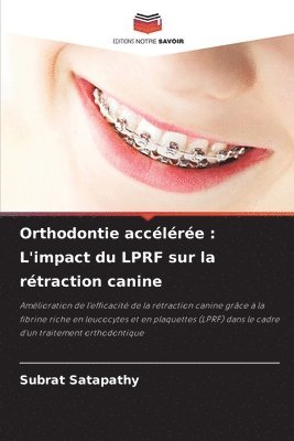 bokomslag Orthodontie accélérée: L'impact du LPRF sur la rétraction canine