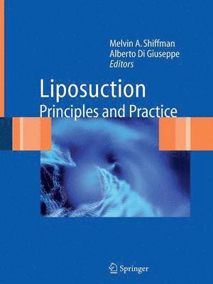 Liposuction 1