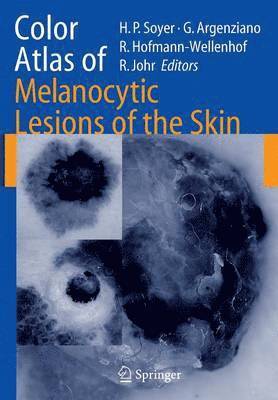 Color Atlas of Melanocytic Lesions of the Skin 1