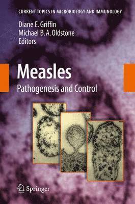 Measles 1