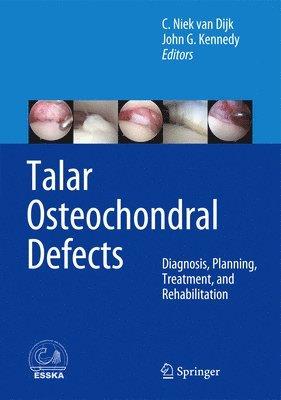 Talar Osteochondral Defects 1