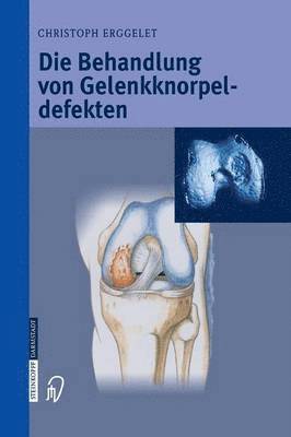 Die Behandlung von Gelenkknorpeldefekten 1