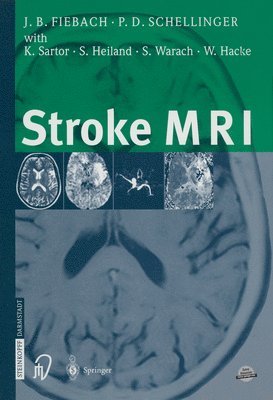 Stroke MRI 1