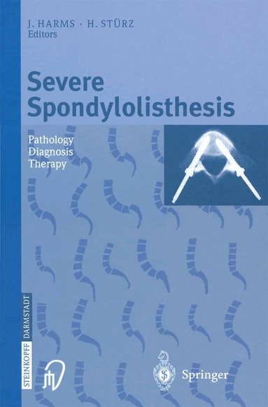 J. Harms, H. Stürz - Severe Spondylolisthesis, Häftad
