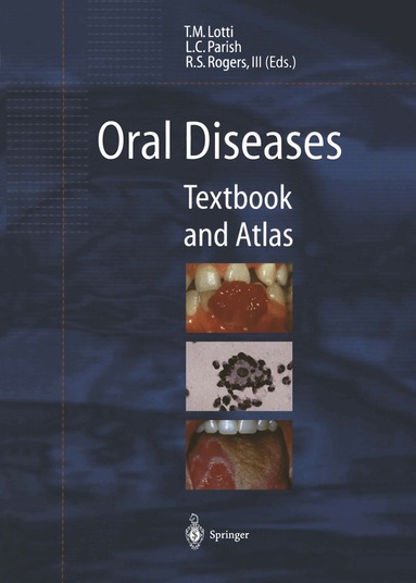 Torello M. Lotti, Lawrence C. Parish, Roy S.III Rogers - Oral Diseases, Häftad