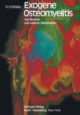 bokomslag Exogene Osteomyelitis von Becken und unteren Gliedmaßen