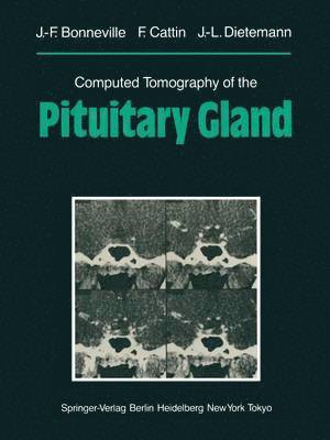 Computed Tomography of the Pituitary Gland 1