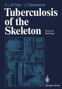 bokomslag Tuberculosis of the Skeleton