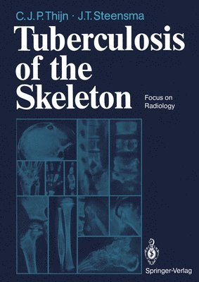 Tuberculosis of the Skeleton 1