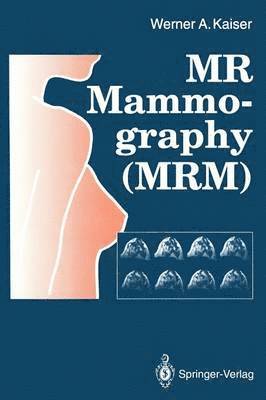 MR Mammography (MRM) 1