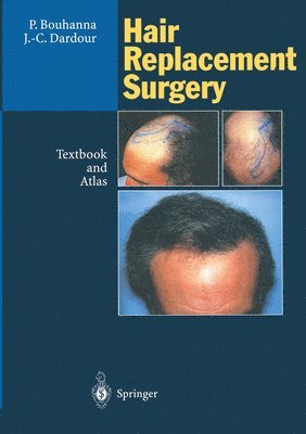 Hair Replacement Surgery 1