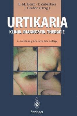 Urtikaria 1