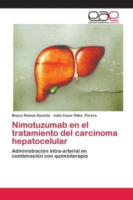 Nimotuzumab en el tratamiento del carcinoma hepatocelular 1