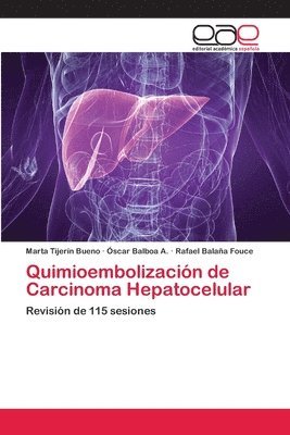 Quimioembolizacin de Carcinoma Hepatocelular 1