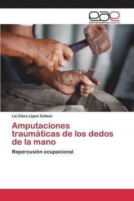 Amputaciones traumticas de los dedos de la mano 1