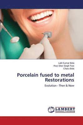 Porcelain fused to metal Restorations 1