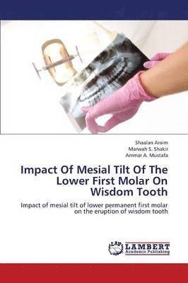 Impact of Mesial Tilt of the Lower First Molar on Wisdom Tooth 1