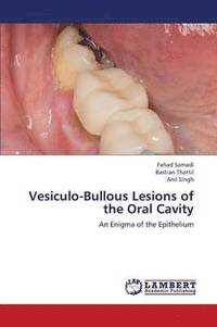 bokomslag Vesiculo-Bullous Lesions of the Oral Cavity