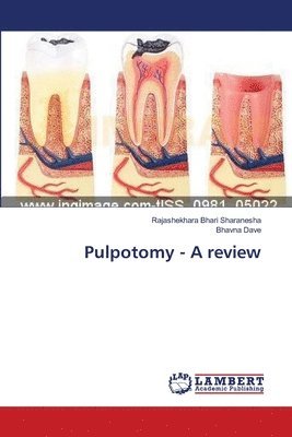 Pulpotomy - A review 1