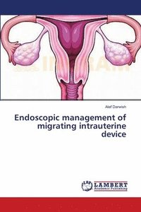 bokomslag Endoscopic management of migrating intrauterine device