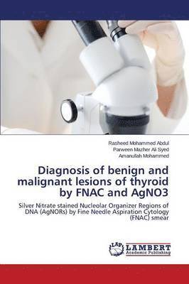 Diagnosis of benign and malignant lesions of thyroid by FNAC and AgNO3 1