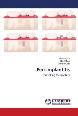 bokomslag Peri-implantitis