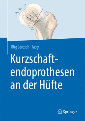 bokomslag Kurzschaftendoprothesen an der Hfte