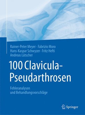 100 Clavicula-Pseudarthrosen 1