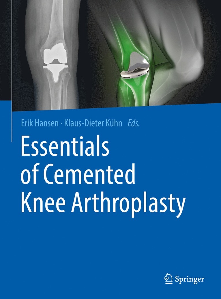 Essentials of Cemented Knee Arthroplasty