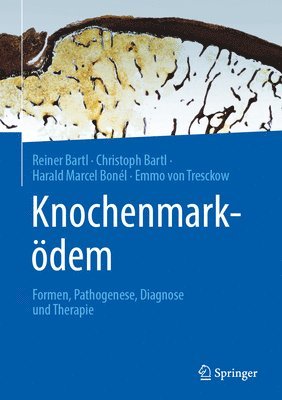 Reiner Bartl, Christoph Bartl, Harald Marcel Bonél, Emmo von Tresckow, Emmo von Tresckow - Knochenmarködem, Inbunden