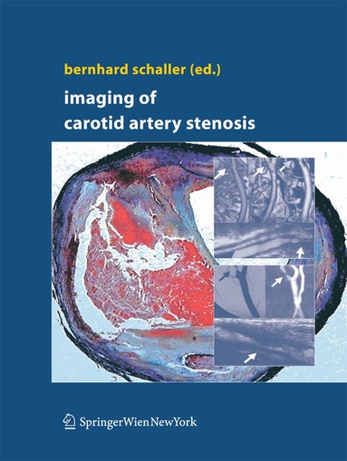 Bernhard Schaller - Imaging of Carotid Artery Stenosis, Häftad