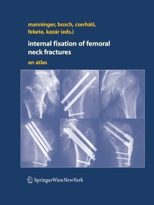 Internal fixation of femoral neck fractures 1