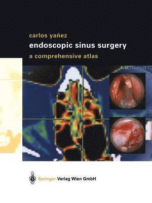 bokomslag Endoscopic Sinus Surgery