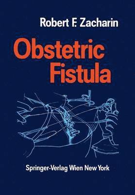 Obstetric Fistula 1