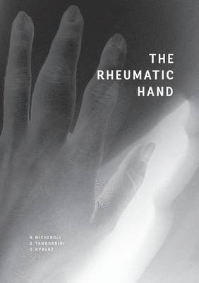 Rheumatic Hand