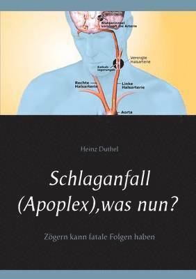 bokomslag Schlaganfall (Apoplex), was nun?